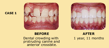 Case 1 before and after dental crowding photo