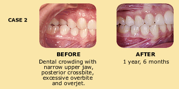 Case 2 before and after dental crowding photo