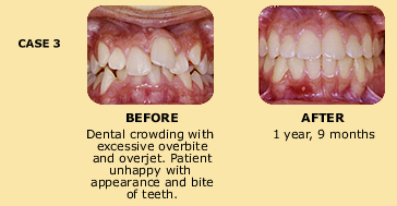 Case 3 before and after dental crowding photo