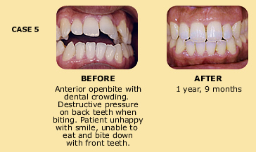 Case 5 before and after dental crowding photo